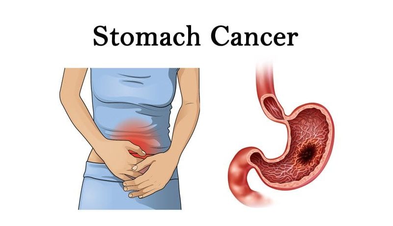 Stomach Cancer Causes Symptoms And Treatment Magazineup