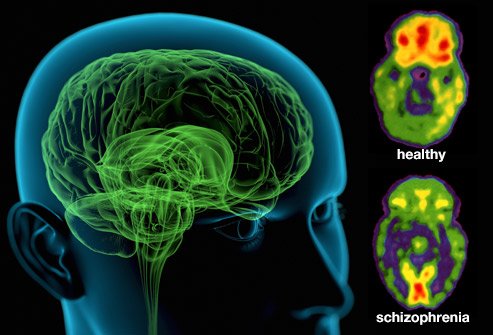 Schizophrenia - Symptoms and causes