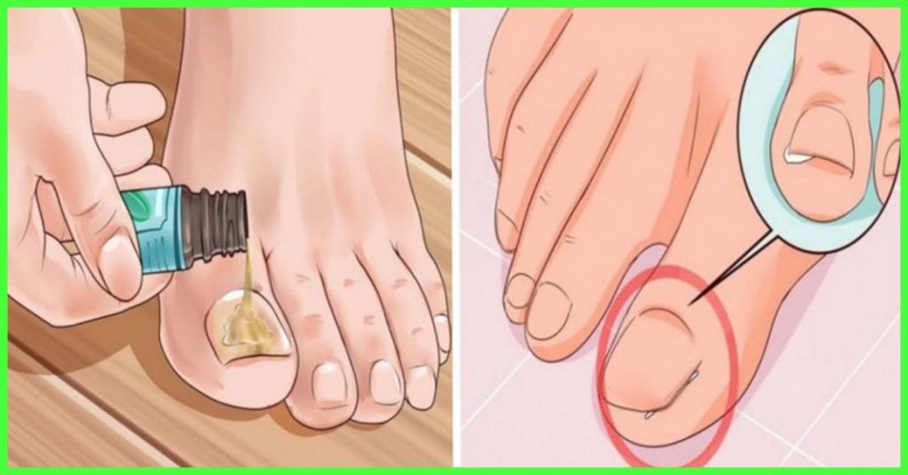 Top 36 Home Remedies To Treat Nail Fungus 1 scaled