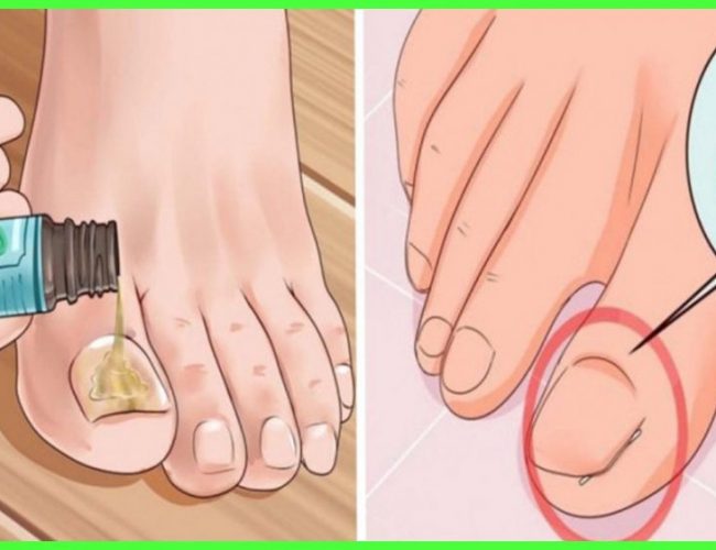 The best home remedies for nail fungus