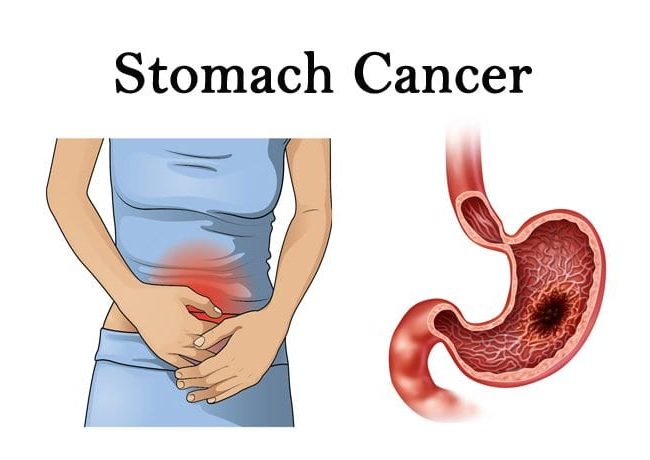 Stomach Cancer-Causes, Symptoms, and Treatment