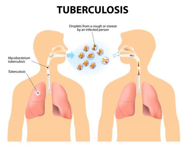 Tuberculosis