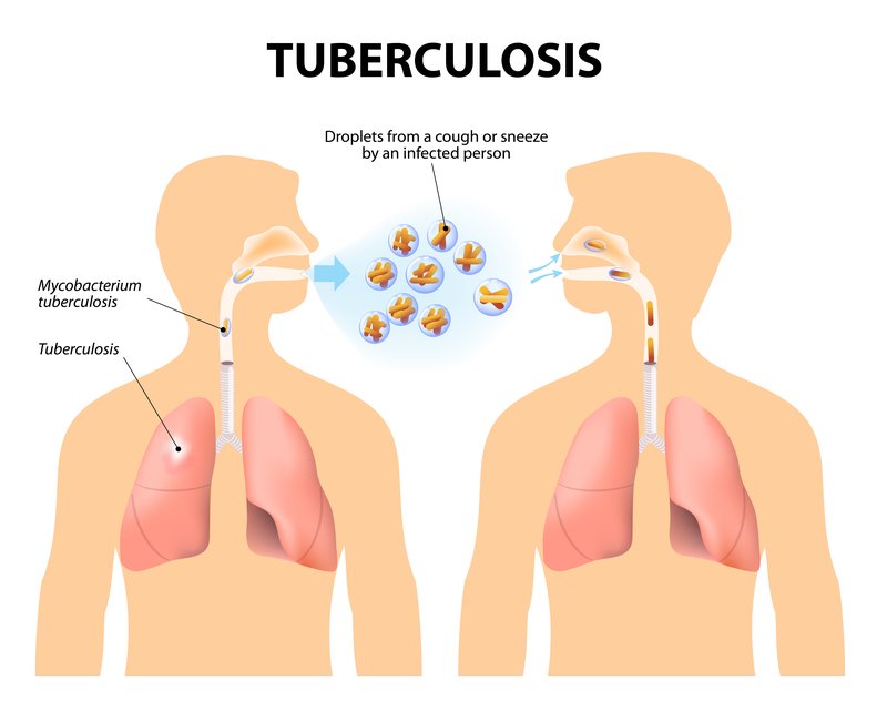 Tuberculosis Symptoms And Treatment | Health Alert I Magazineup