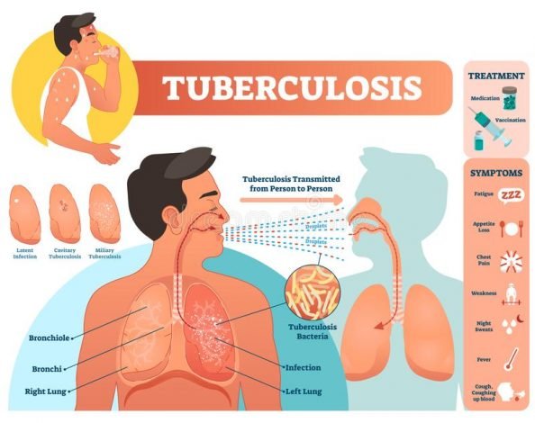 Tuberculosis, Magazineup