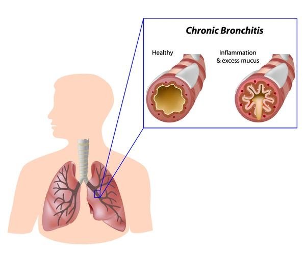 chronic_bronchitis