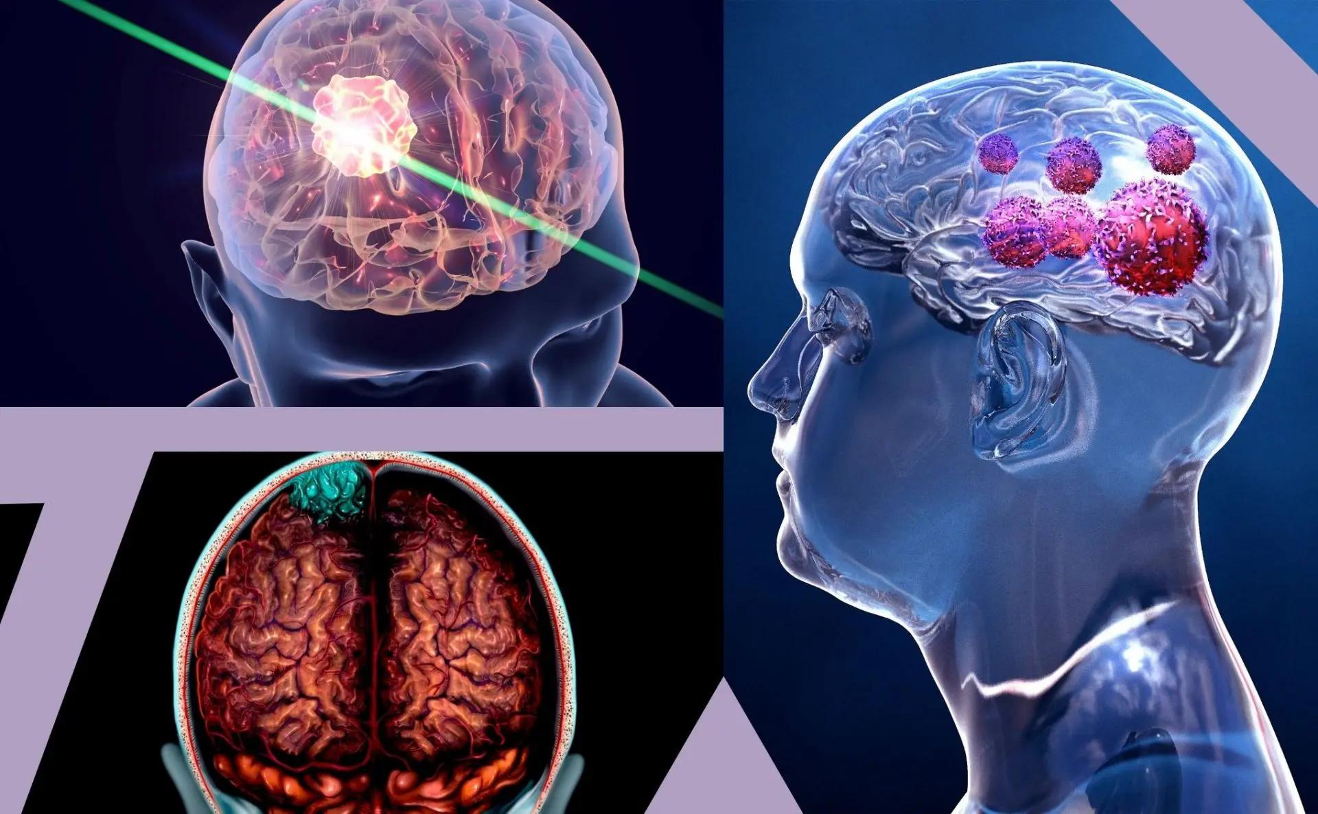 Brain Cancer – Symptoms & Diagnosis