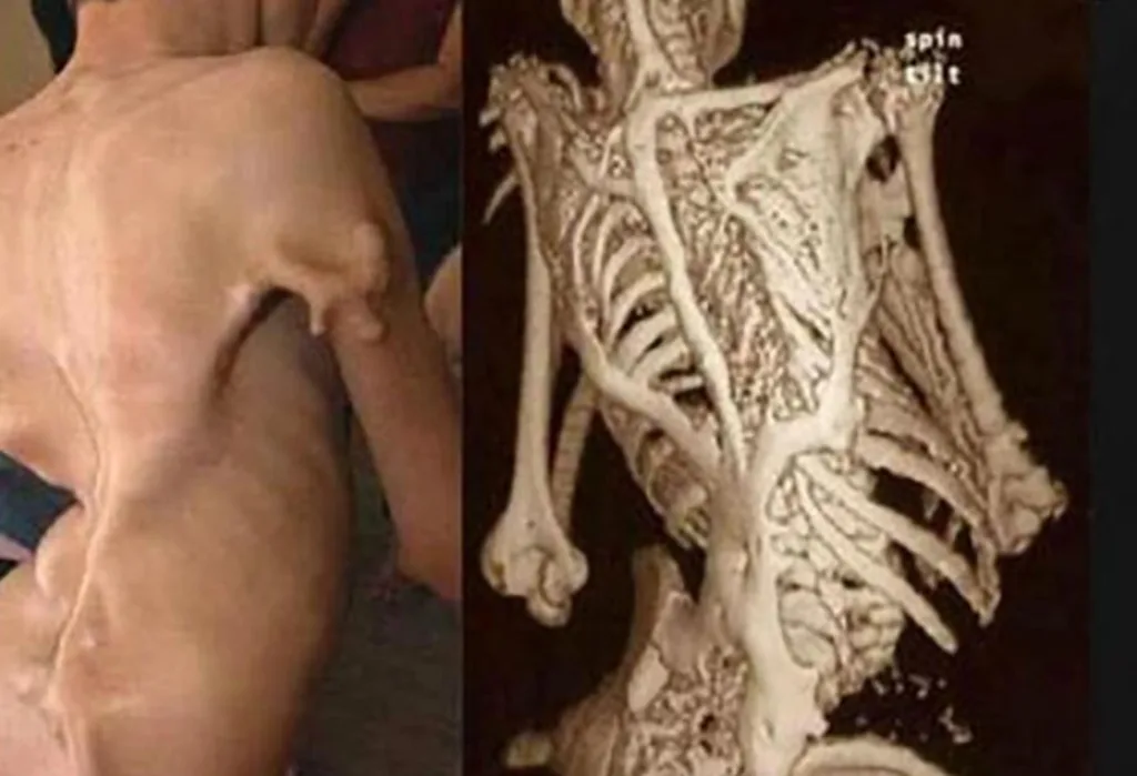 Fibrodysplasia Ossificans Progressiva (Stoneman Syndrome)