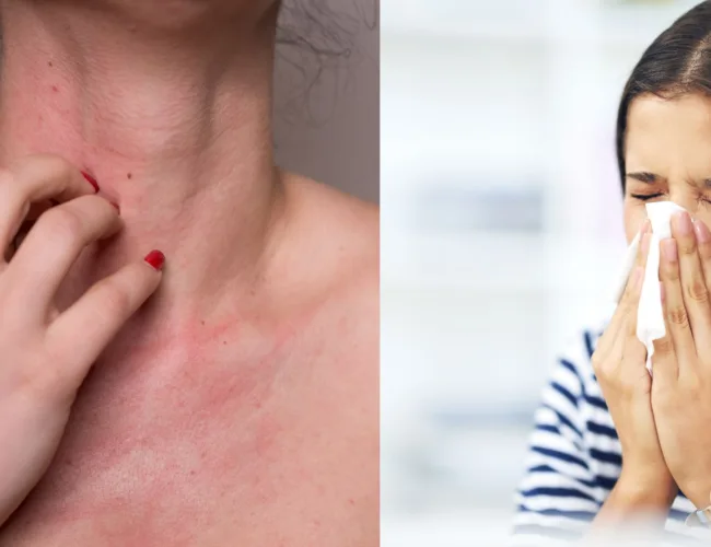 What to know about aquagenic urticaria(water allergies)?